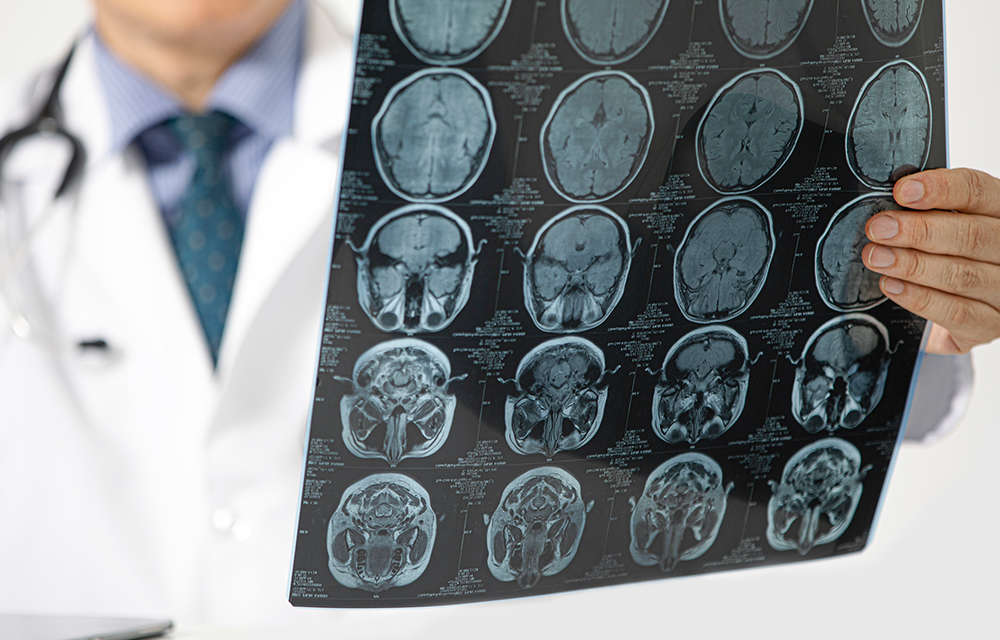 Neurologia: Știința creierului și sănătatea sistemului nervos la Aria Clinic